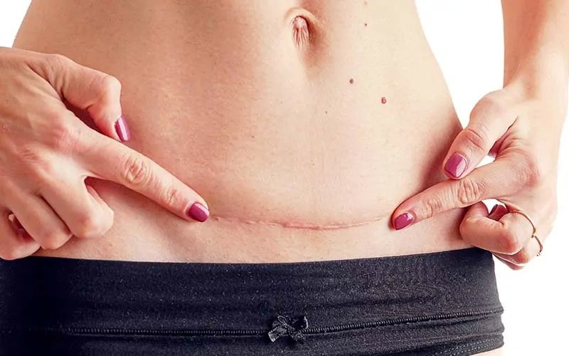 Blog - Normal Doğum mu Sezaryen mi? Anne Adayları İçin Doğru Tercih Rehberi